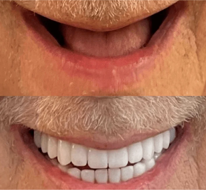 Before and After dentures