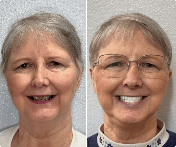 Clients before and after implants