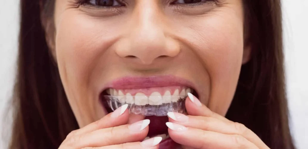 Invisible Aligners